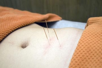 Dry needling
